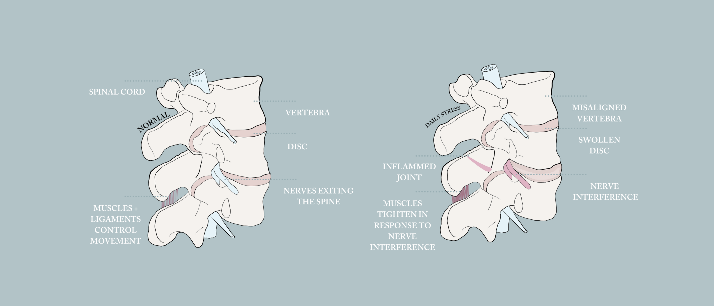 A visual comparison highlighting the benefits of proper spinal alignment. On the left, a 'normal' spine shows vertebrae stacked correctly with a healthy disc, allowing nerves to exit freely. On the right, a spine under 'daily stress' is shown with a misaligned vertebra, a swollen disc, and an inflamed joint, leading to 'nerve interference' and tightened muscles. This illustrates how the Curv Pillow works to support natural spinal alignment, helping to alleviate the effects of daily stress and promote a heal